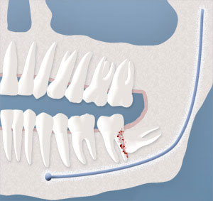 wisdom teeth removal East York