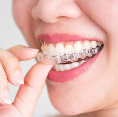 Invisalign treatment in East York